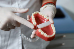 dottoressa laganà spiega invisalign