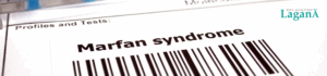 sindrome-marfan